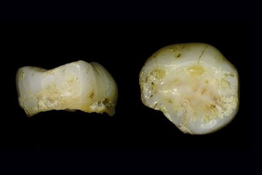Un dente da latte di 13.000 anni fa racconta i movimenti dei cacciatori-raccoglitori nel Nord Italia